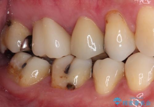 奥歯が痛い セラミッククラウンでの虫歯治療の治療後