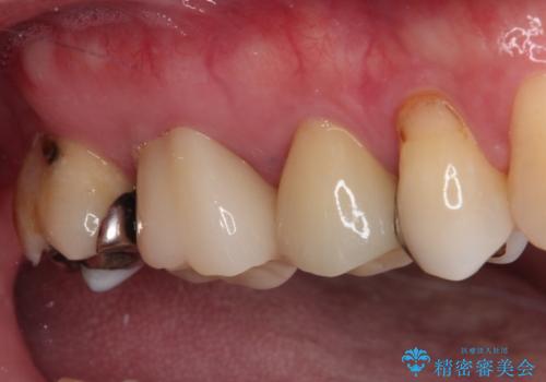奥歯が痛い セラミッククラウンでの虫歯治療の治療後