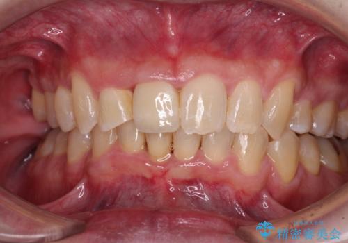 前歯が折れたついでに歯並びも改善　矯正治療と前歯のセラミック治療の症例 治療後