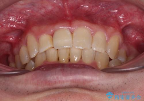 前歯が折れたついでに歯並びも改善 矯正治療と前歯のセラミック治療の治療後