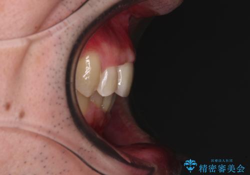 前歯が折れたついでに歯並びも改善 矯正治療と前歯のセラミック治療の治療後