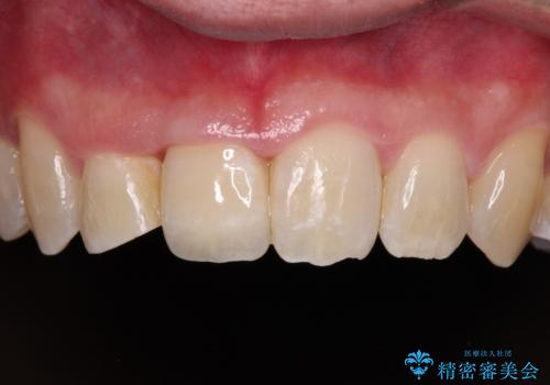 前歯が折れたついでに歯並びも改善　矯正治療と前歯のセラミック治療の治療後