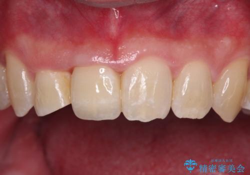 前歯が折れたついでに歯並びも改善 矯正治療と前歯のセラミック治療の治療後