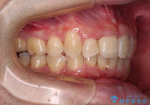 前歯が折れたついでに歯並びも改善 矯正治療と前歯のセラミック治療の治療後