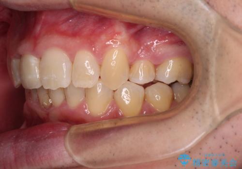 前歯が折れたついでに歯並びも改善 矯正治療と前歯のセラミック治療の治療後