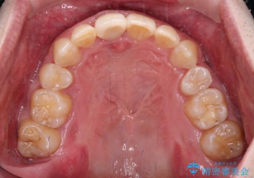 前歯が折れたついでに歯並びも改善 矯正治療と前歯のセラミック治療の治療後
