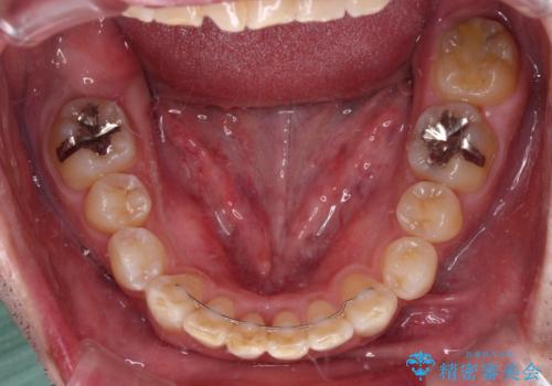 前歯が折れたついでに歯並びも改善 矯正治療と前歯のセラミック治療の治療後