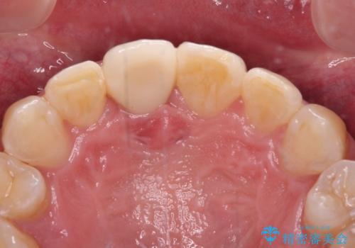 前歯が折れたついでに歯並びも改善 矯正治療と前歯のセラミック治療の治療後