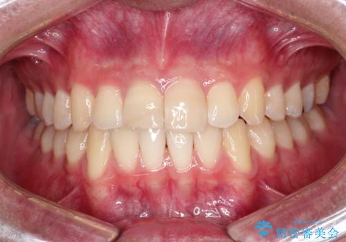 【ホワイトニング】右上前歯の歯茎の辺りが暗いのが気になる。の治療後