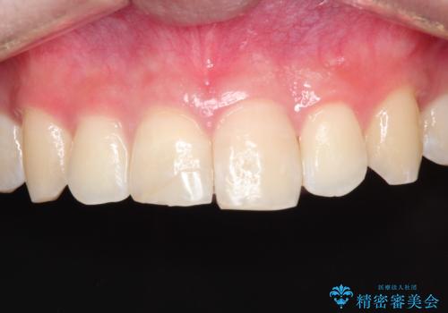 【ホワイトニング】右上前歯の歯茎の辺りが暗いのが気になる。の治療後