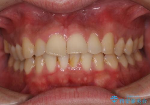 ほうじ茶による着色をPMTCで綺麗にの治療前