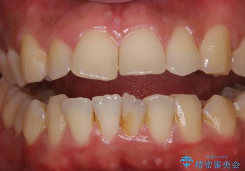 ほうじ茶による着色をPMTCで綺麗にの治療前