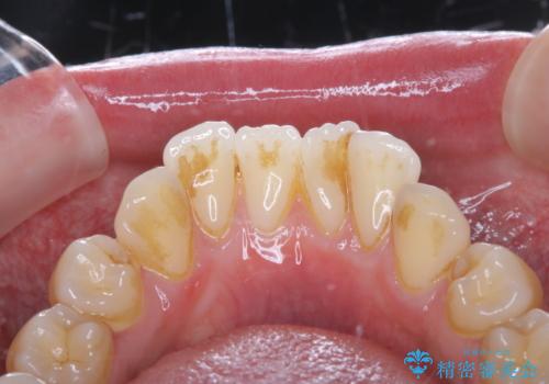 ほうじ茶による着色をPMTCで綺麗に