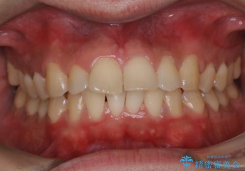 ほうじ茶による着色をPMTCで綺麗にの治療後