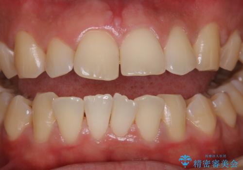 ほうじ茶による着色をPMTCで綺麗にの治療後