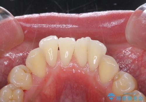 ほうじ茶による着色をPMTCで綺麗にの症例 治療後