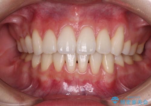 【モニター】気になる八重歯を素早く改善　ワイヤー装置での抜歯矯正の症例 治療後