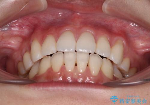 【モニター】気になる八重歯を素早く改善 ワイヤー装置での抜歯矯正の治療後
