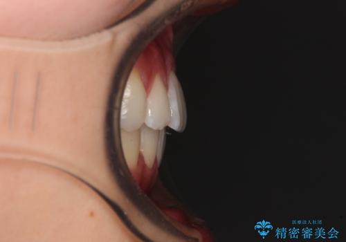 【モニター】気になる八重歯を素早く改善 ワイヤー装置での抜歯矯正の治療後