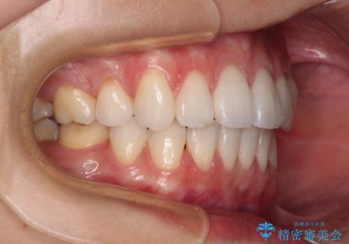 【モニター】気になる八重歯を素早く改善　ワイヤー装置での抜歯矯正の治療後
