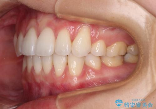 【モニター】気になる八重歯を素早く改善　ワイヤー装置での抜歯矯正の治療後