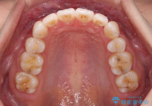 【モニター】気になる八重歯を素早く改善 ワイヤー装置での抜歯矯正の治療後