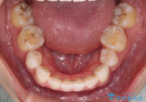 【モニター】気になる八重歯を素早く改善 ワイヤー装置での抜歯矯正の治療後