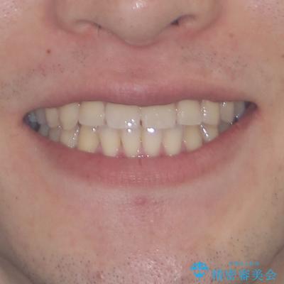 八重歯と前歯のクロスバイト　ワイヤー装置で短期間矯正の治療後（顔貌）
