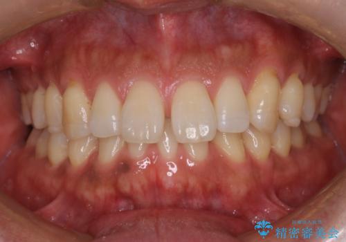 『前歯のすき間を短期間で治したい』インビザライン(枚数制限あり)症例の症例 治療前