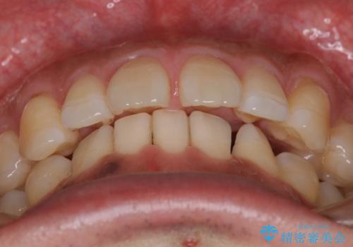 『前歯のすき間を短期間で治したい』インビザライン(枚数制限あり)症例の治療前