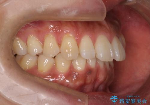 『前歯のすき間を短期間で治したい』インビザライン(枚数制限あり)症例の治療前