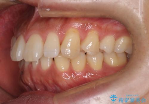 『前歯のすき間を短期間で治したい』インビザライン(枚数制限あり)症例の治療前