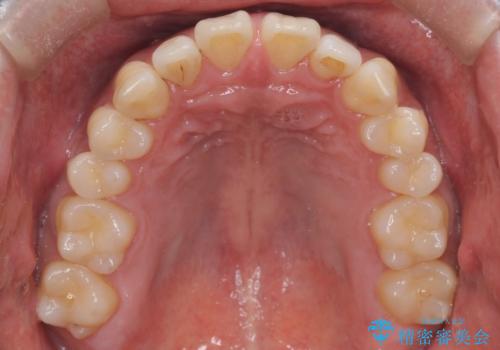 『前歯のすき間を短期間で治したい』インビザライン(枚数制限あり)症例の治療前