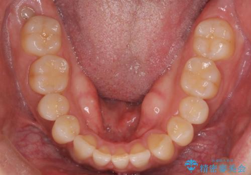 『前歯のすき間を短期間で治したい』インビザライン(枚数制限あり)症例の治療前