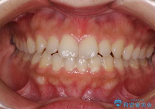 インビザラインを用いた上顎の部分矯正の症例 治療前