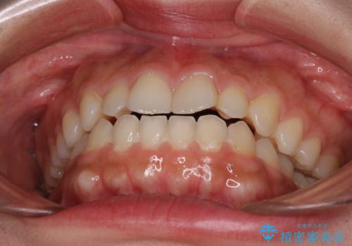 インビザラインを用いた上顎の部分矯正の治療前