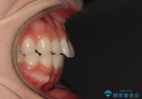 インビザラインを用いた上顎の部分矯正の治療前