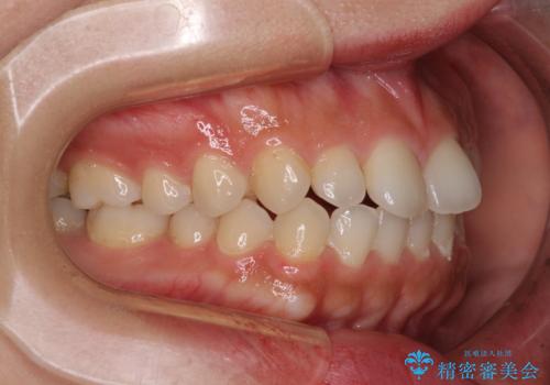インビザラインを用いた上顎の部分矯正の治療前
