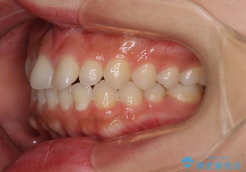 インビザラインを用いた上顎の部分矯正の治療前