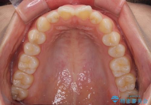 インビザラインを用いた上顎の部分矯正の治療前