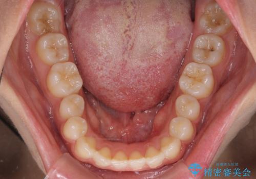 インビザラインを用いた上顎の部分矯正の治療前