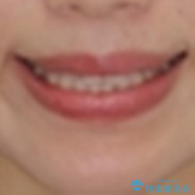 インビザラインを用いた上顎の部分矯正の治療前(顔貌)