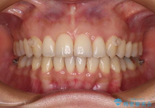 矯正治療の後戻り インビザライン・ライトによる矯正治療の治療中