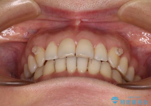 矯正治療の後戻り インビザライン・ライトによる矯正治療の治療中