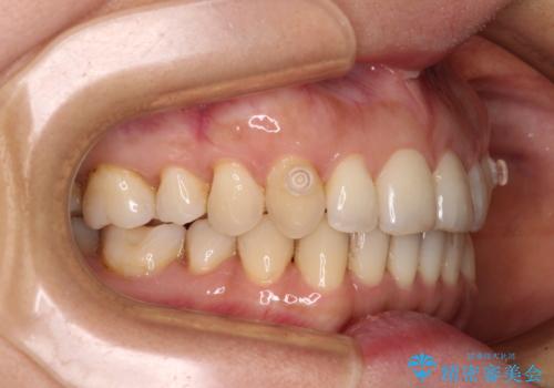 矯正治療の後戻り インビザライン・ライトによる矯正治療の治療中