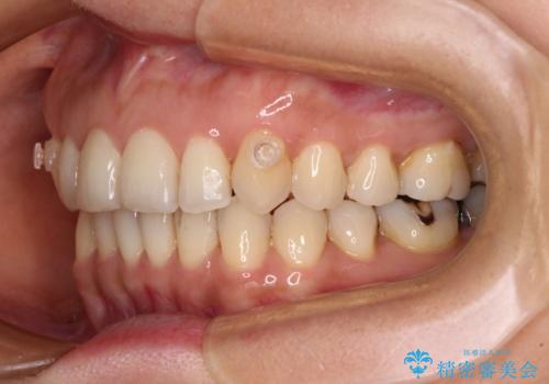 矯正治療の後戻り インビザライン・ライトによる矯正治療の治療中