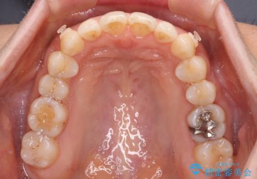 矯正治療の後戻り インビザライン・ライトによる矯正治療の治療中