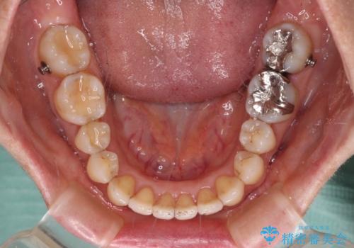 矯正治療の後戻り インビザライン・ライトによる矯正治療の治療中