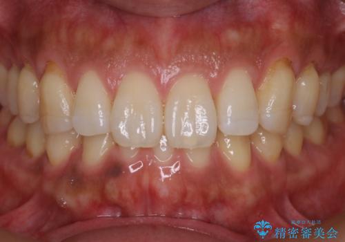 『前歯のすき間を短期間で治したい』インビザライン(枚数制限あり)症例の症例 治療後