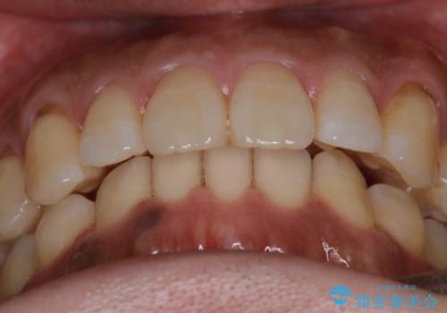 『前歯のすき間を短期間で治したい』インビザライン(枚数制限あり)症例の治療後